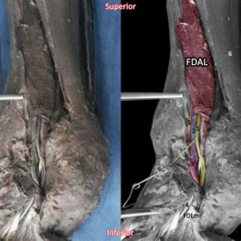 Nontraumatic rupture of achilles tendon (approximate match). Bilateral case (left leg). FDALM - flexor digitorum accesorius longus... | Download Scientific ...