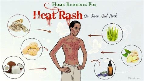 36 Home Remedies For Heat Rash On Face And Neck Heat Rash On Face