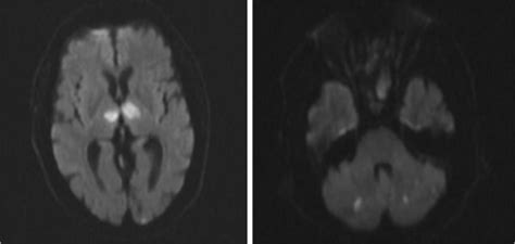 Subarachnoid hemorrhage (sah) is bleeding into the subarachnoid space—the area between the arachnoid membrane and the pia mater surrounding the brain. Diffusion weighted imaging showing multiple punctate foci ...