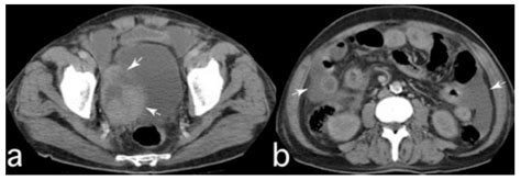 Abdominal Ct Examination A Pelvic Sections Showing A Mass Arrows