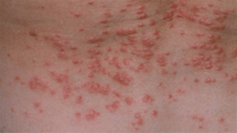 Scabies In Images