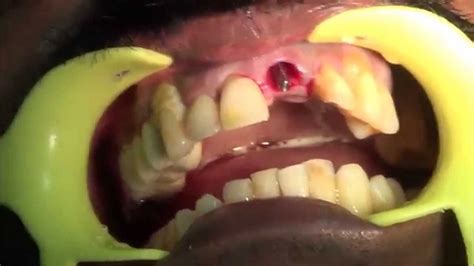 Upper Front Infected Tooth Extraction And Immediate Implantation