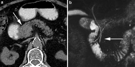 Pancreas Divisum Ct A Shows A Widened Pancreatic Head White Arrow