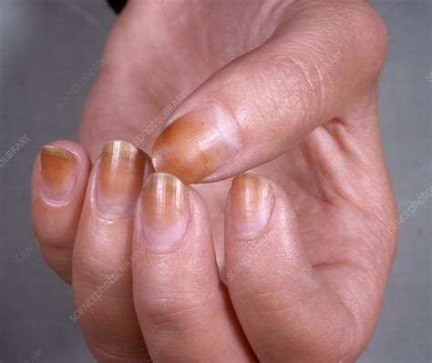 Discoloured Fingernails Stock Image C0494519 Science Photo Library