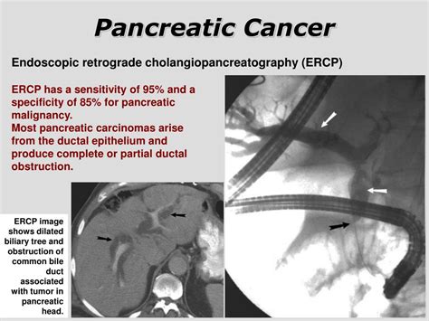 Ppt Pancreatic Cancer Powerpoint Presentation Free Download Id3295800