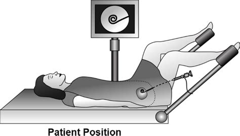 Cystoscopy And Ureteral Stent Placement