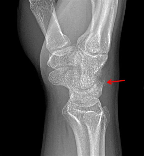Triquetral Fracture Radiology