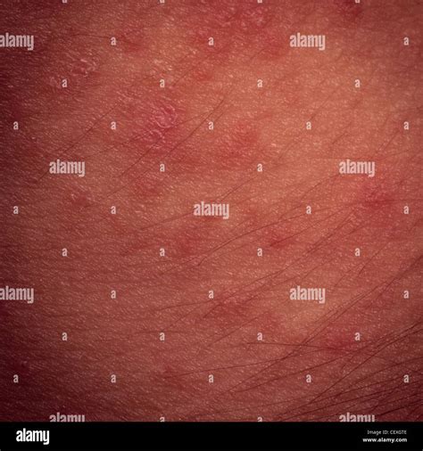 Eczema Groin Atopic Dermatitis Symptom Of Skin Texture Stock Photo Images