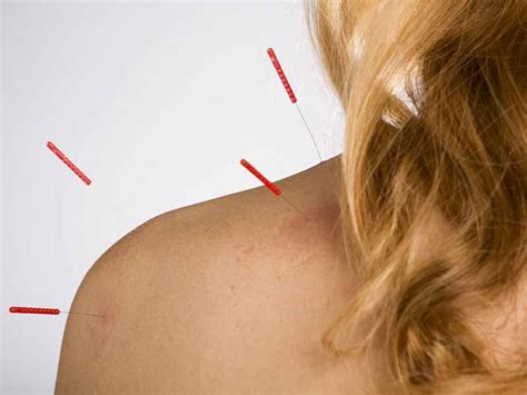 Research Finds Acupuncture Effective For Chronic Pain