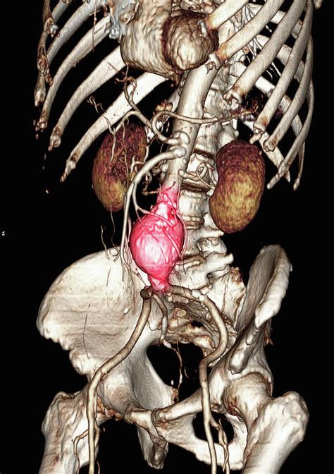 Ct Scan Image Showing An Abdominal Aortic Aneurysm Digital Art By