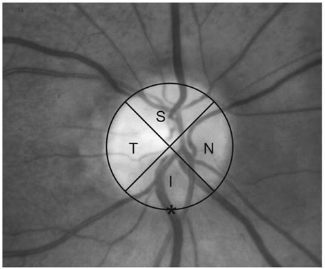 Optic Disc Brightness Score Evaluation Method T Temporal S