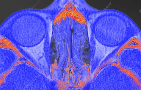 Paranasal Sinuses 3d Ct Scan Stock Image C0492679 Science Photo