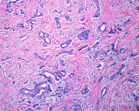 Invasive Carcinoma Of The Breast 4 Photograph By Jose Calvoscience