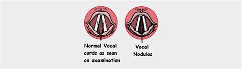 Vocal Cord Nodules Homeopathic Treatment I Causes And Symptoms