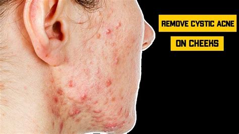 How To Get Rid Of Cystic Acne On Cheeks 7 Home Remedies To Remove Acne On Face Naturally