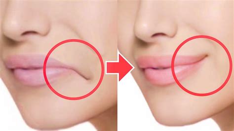 Fix Droopy Mouth Corners Remove Fat Around The Mouth Lower Cheeks