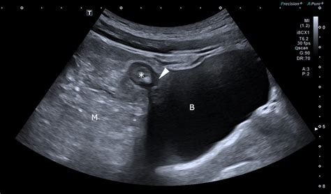 Intestinal Ultrasound Showing Entero‐vesical Fistula Asterisk