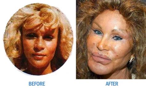 Who S Celebrity Plastic Surgery Too Muchcelebrity