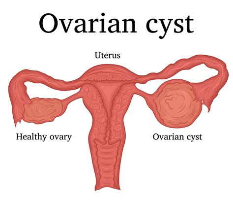 understanding ovarian cysts causes symptoms and treatment options ijenwa fertility