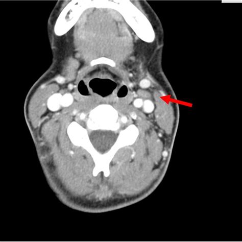Ct Scan Of The Head With Submandibulary Gland Tumor Multiple Nodes And