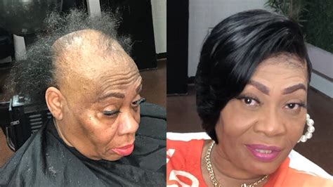 Must Watch Alopecia Areata Transformation Layed Quickweave Bob