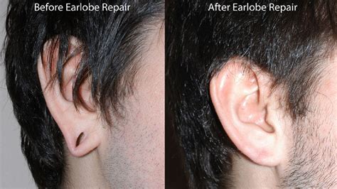 Photos Before And After Earlobe Surgery Abc13 Houston
