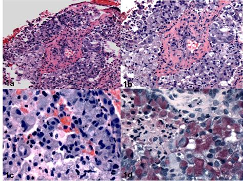 Figure 1 Photomicrograph Showing Mucinous Carcinoma With Signet Ring