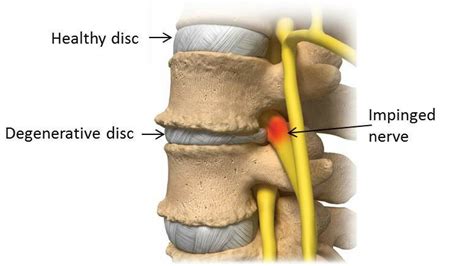 lumbar disc disease