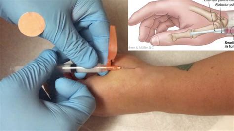 Injections On The Elbow Wrist And Hand Sports Medicine Review