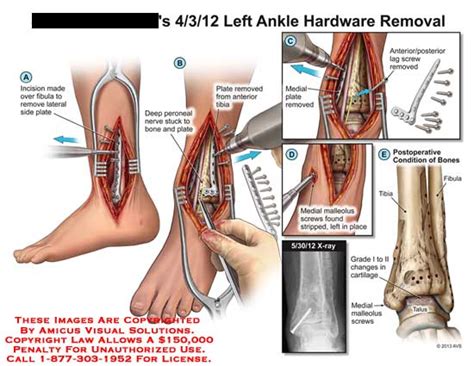 High association of posterior malleolus fractures with spiral distal tibia fractures. Medical Exhibits, Demonstrative Aids, Illustrations and Models