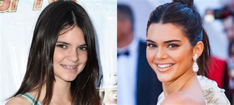 Stars Whose Braces Before And After Images Define Hollywood Smile