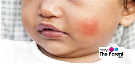 Insect Bites First Aid And Home Remedies Being The Parent