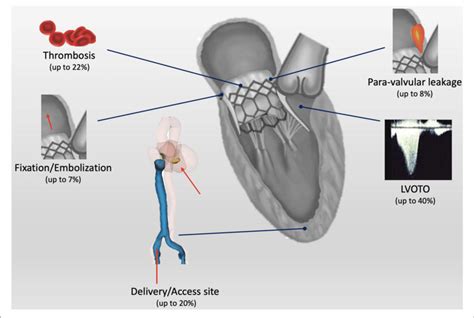 Central Illustration Current Open Issues For Transcatheter Mitral
