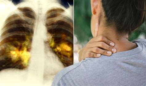 Lung Cancer Symptoms Unusual Signs Of A Tumour Include A Swollen Neck And Hoarseness Express