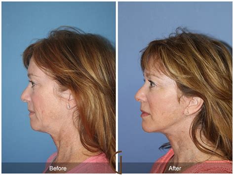 Facial Fat Grafting Before And After Photos Patient 24 Dr Kevin Sadati