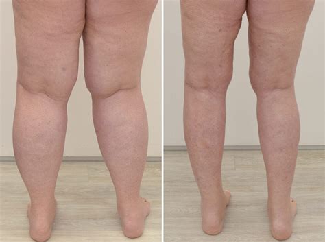 Patient Story Emma Granzow Lymphedema And Lipedema Center
