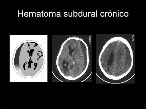 Sintomas De Un Hematoma Subdural Cronico Wrocawski Informator