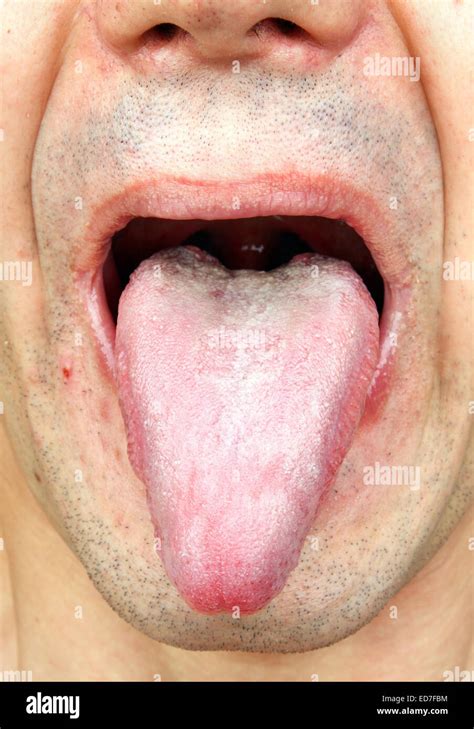 Anemia Tongue Hi Res Stock Photography And Images Alamy