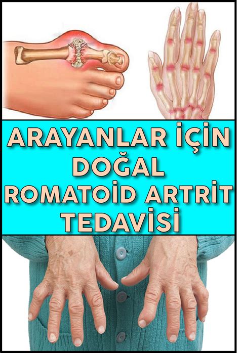 Arayanlar İçin Doğal Romatoid Artrit Tedavisi | Artrit, Romatoid artrit ...
