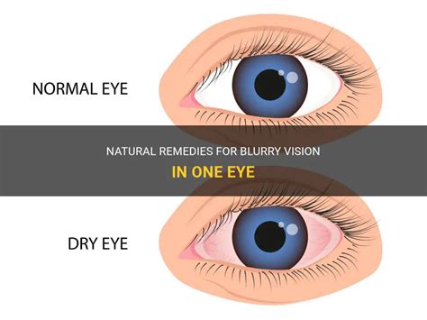 Natural Remedies For Blurry Vision In One Eye Medshun