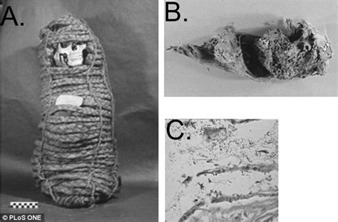 Antibiotic Resistant Bacteria Found In Guts Of Incan Mummies Daily