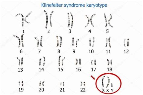 Klinefelter Syndrome Men Carry The Female Gene