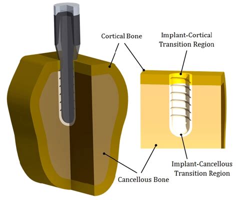 A Sectional View Of Implant Cortical And Cancellous Bones And