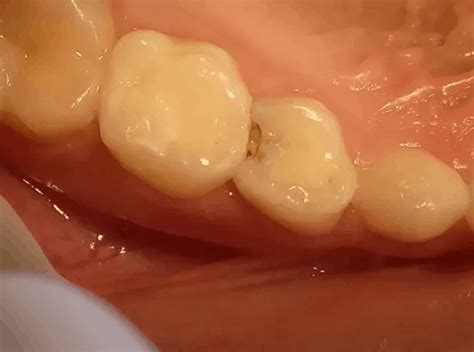 What Does A Cavity Look Like Identifying Tooth Decay