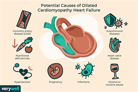 Enlarged Heart Treatment