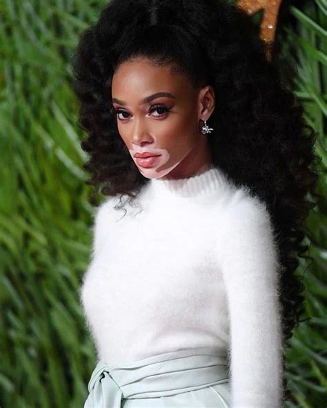 Model Winnie Harlow Wants Everyone To Know She Isnt Suffering From