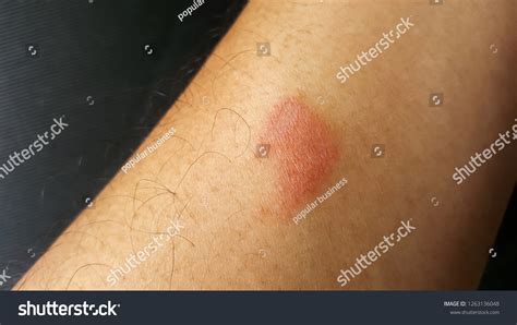 Closeup Centipede Bite Poisonous Hurt Arm Foto Stock 1263136048