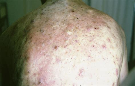 Diseases Of The Sebaceous Glands Sebocystoma Picture Hellenic