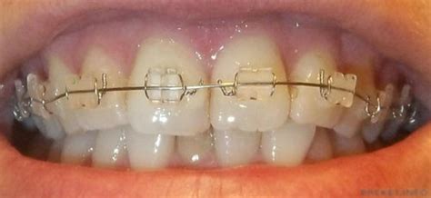 Maybe you would like to learn more about one of these? Tooth discoloration after braces. How to clean/get rid of ...