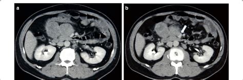 Abdominal Computerized Tomography Ct Showing Two In Homogeneously